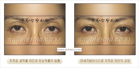 [두한성형외과 경쟁력 쌍꺼풀 재수술] - [쌍꺼풀 재수술 과정] 관련 이미지 91