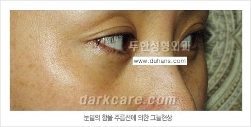 [두한성형외과 경쟁력 눈밑성형] - [다크써클의 원인과 다크써클의 종류] 관련 이미지 4