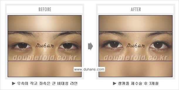 [두한성형외과 쌍꺼풀 재수술] - [지나친 아웃폴드 라인의 쌍꺼풀 재수술] 관련 이미지 5