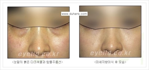 [두한성형외과 경쟁력 눈밑성형] - [다크써클 수술 안내 2.] 관련 이미지 7