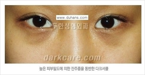 [두한성형외과 경쟁력 눈밑성형] - [다크써클의 원인과 다크써클의 종류] 관련 이미지 8