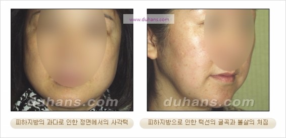 [두한성형외과 경쟁력 지방흡입] - [볼살, 턱선의 간편 지방흡입] 관련 이미지 2