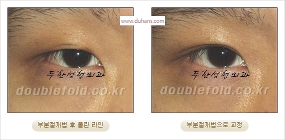 [두한성형외과 경쟁력 쌍꺼풀 재수술] - [풀린 라인 교정(Correction released fold line) 방법] 관련 이미지 9