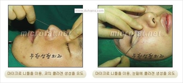 [두한성형외과 경쟁력 눈밑성형] - [눈밑 다크써클 치료에 대한 자주하는 질문과 답변 모음 안내] 관련 이미지 3
