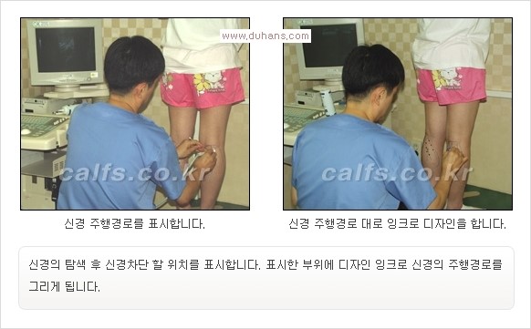 [두한성형외과 경쟁력 멀티종아리성형] -  [종아리 축소술의 여러 가지 종류] 관련 이미지 12
