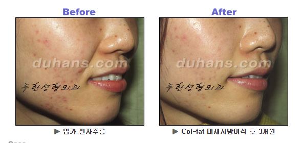 Nasolabial Fold Fat Grafting: How Can You Improve Fat Retention and Naturalness? image 1