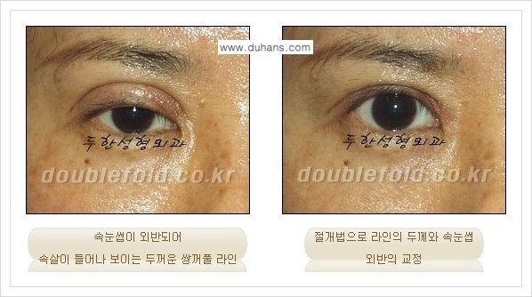 [두한성형외과 경쟁력 쌍꺼풀 재수술, 극한 재수술] - [속눈썹 외반 수술 방법 안내] 관련 이미지 7