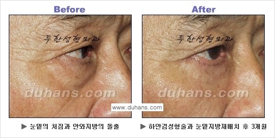 [두한성형외과의 상큼하고 환한 젊은 눈매완성] - [하안검 성형술 ①] 관련 이미지 13