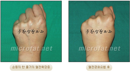 [Duhan Plastic Surgery Clinic Varicose Veins] - [Hand and Arm Venous Dilation] image 10