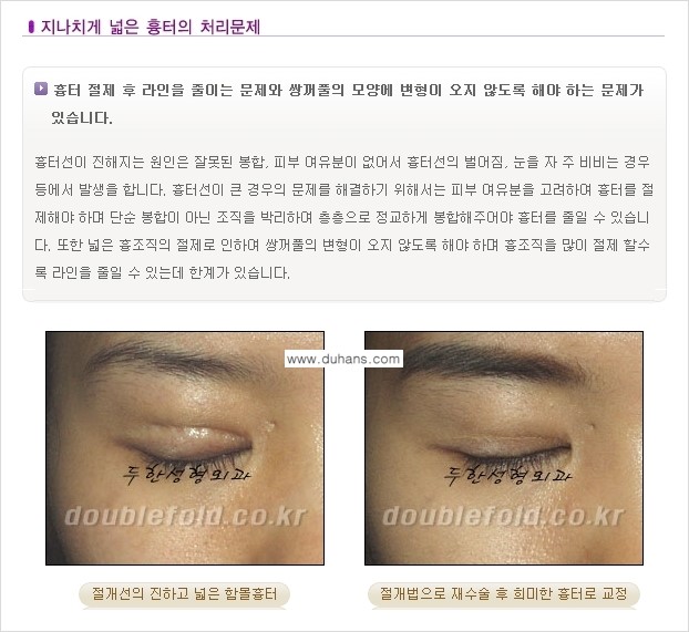 [두한성형외과 극한 재수술, 쌍꺼풀 재수술] - [쌍꺼풀 재수술에서 극복해야 할 극한의 상황과 문제] 관련 이미지 3