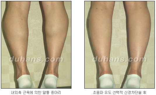 [Duhan Plastic Surgery Calf Reduction] - [How to Get Rid of Calf Muscle Bulges] image 25