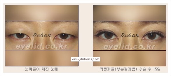 [두한성형외과 경쟁력 눈성형] - [퀵쌍꺼풀(부분절개법) 안내] 관련 이미지 2