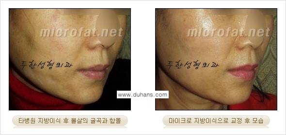 [두한성형외과 경쟁력 미세지방이식] - [타 병원에서 볼살 지방이식 이후 부작용 교정 방법 안내] 관련 이미지 7