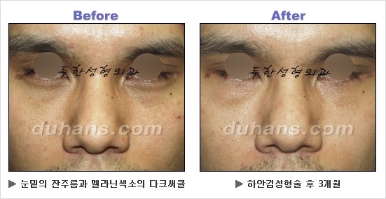 [두한성형외과 경쟁력 동안성형 리더] - ​[미간주름, 이마주름, 안검성형, 이마거상술, 눈썹거상술] 관련 이미지 116