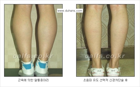 [두한성형외과] - [가을엔 아름답고 매끈한 다리 도전!​] 관련 이미지 1