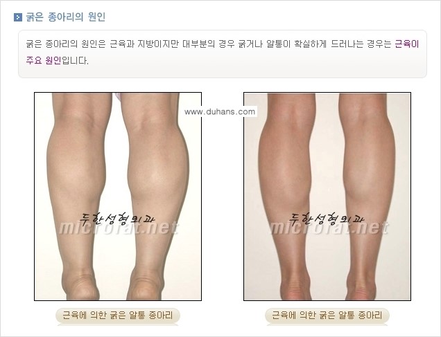 [두한성형외과 경쟁력 멀티종아리성형] - [초음파 유도 비절개 선택적 신경차단술의 효과] 관련 이미지 4