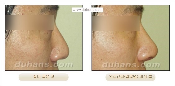 [두한성형외과 경쟁력 코성형] - [코성형을 위한 알로덤(슈어덤) 수술, 실리콘 수술 안내] 관련 이미지 17