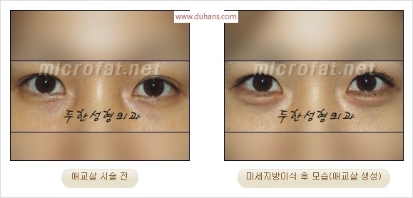​﻿[두한성형외과 경쟁력 지방이식] - [눈밑 애교살 시술을 위한 미세지방이식] 관련 이미지 27