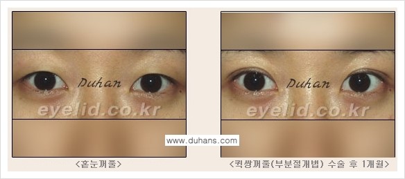 [두한성형외과 FOCUS 눈성형] - [퀵쌍꺼풀에 대한 질문과 답변들] 관련 이미지 2