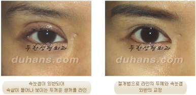 두한성형외과 눈재수술 - 쌍꺼풀 재수술 방법 관련 이미지 43