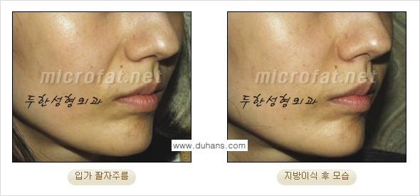 [두한성형외과의 경쟁력 있는 지방이식] - [입가주름, 팔자주름 미세지방이식 1.] 관련 이미지 15