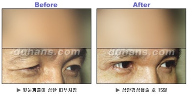 [Duhan Plastic Surgery Blepharoplasty] - [Upper Eyelid Surgery for a Younger-Looking Eye Area] image 12