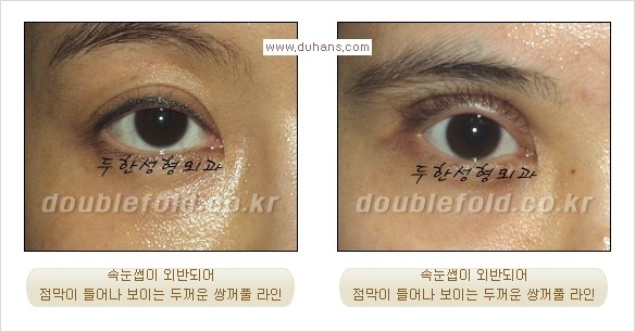 [두한성형외과 경쟁력 쌍꺼풀 재수술, 극한 눈재수술] - [쌍꺼풀 재수술 방법 - 속눈썹 외반] 관련 이미지 2
