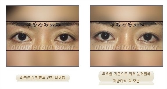 [두한성형외과 경쟁력 쌍꺼풀 재수술] - [쌍꺼풀 재수술 과정] 관련 이미지 101