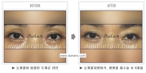 [두한성형외과 쌍꺼풀 재수술] - [과도한 앞트임이 되어있을 경우의 문제] 관련 이미지 4