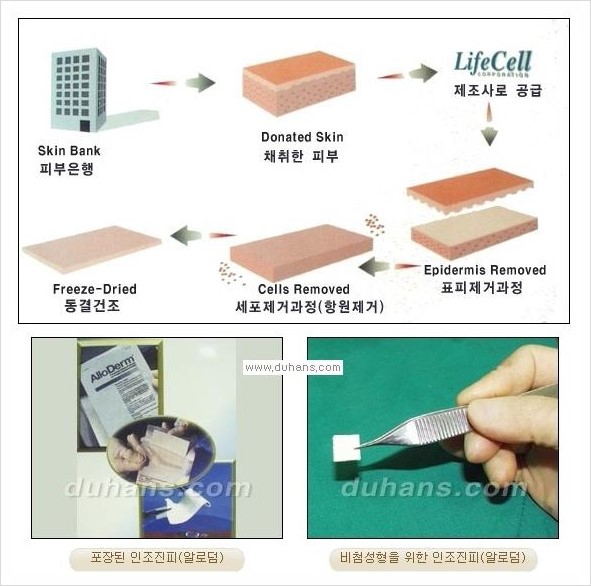 [두한성형외과 경쟁력 코성형 리더] - [자연스럽고 오똑한 콧망울! 코성형 방법]​ 관련 이미지 23
