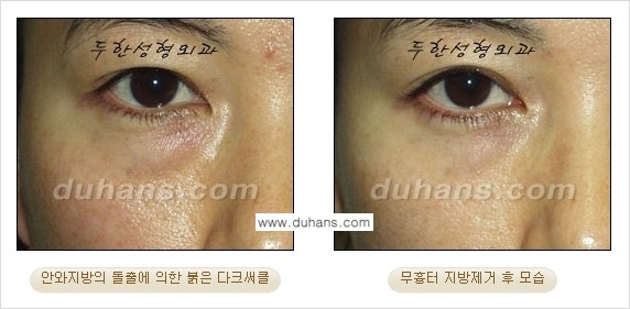 [두한성형외과 경쟁력 지방제거, 지방재배치] - [상큼하고 젊은 눈매 만들기 안내] 관련 이미지 20