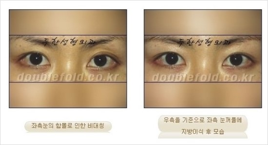 [두한성형외과 경쟁력 눈성형] - [쌍꺼풀 재수술 과정과 쌍꺼풀 재수술 실패의 원인, 쌍꺼풀 재수술의 성공 요건] 관련 이미지 43