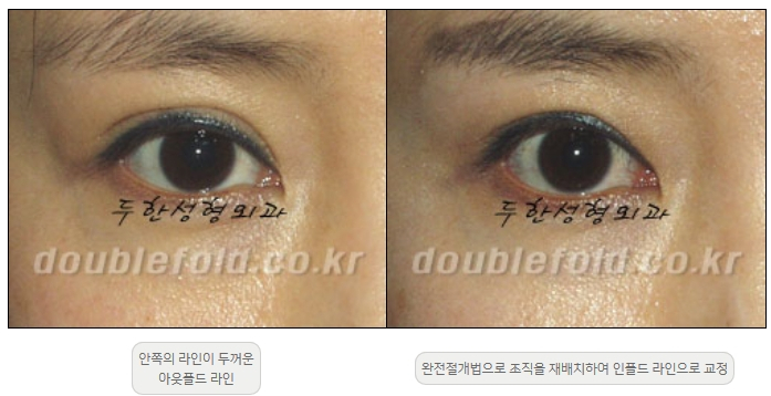 [Double Eyelid Surgery Duhan Plastic Surgery] - [Revision Methods] image 10