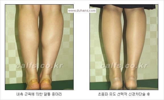 [두한성형외과 Dr. 컬럼] - [종아리 근육퇴축술로 가장 선호하는 비절개 초음파 유도 선택적 신경차단술] 관련 이미지 18