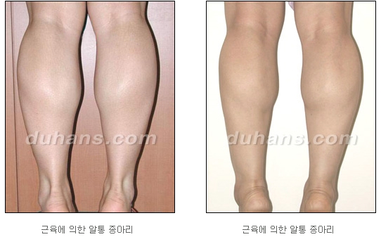 [Duhan Plastic Surgery Calf Reduction] - [How to Get Rid of Calf Muscle Bulges] image 4