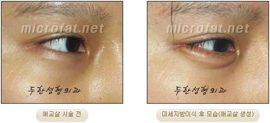 Duhan Plastic Surgery Under-Eye Surgery - Correction with Fat Grafting After Aegyo-Sal Filler image 27