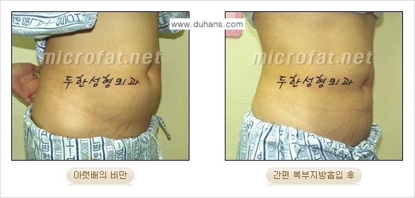 [두한성형외과 겨울엔 지방흡입] - [간편한 복부지방흡입 도전 2.] 관련 이미지 8
