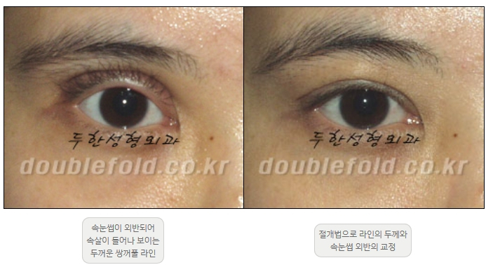 [Double Eyelid Surgery Duhan Plastic Surgery] - [Revision Methods] image 32
