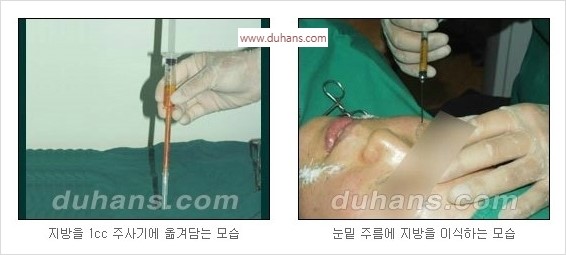[두한성형외과 경쟁력 주름성형] - [지방이식을 이용한 이마주름, 미간주름 제거] 관련 이미지 9