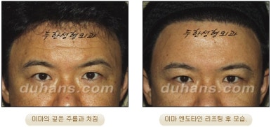 Duhan Plastic Surgery Forehead Surgery - Forehead Lifting Endotine Lifting image 12