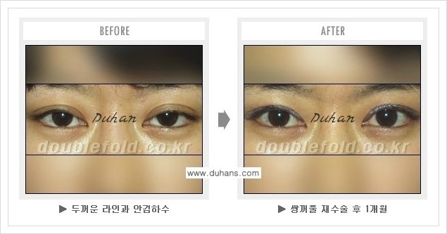 [두한성형외과 경쟁력 쌍꺼풀 재수술, 극한 눈재수술] - [과교정 된 눈매교정] 관련 이미지 5