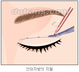 쌍커풀수술 두한성형외과 - 나에게 맞는 눈성형은? 관련 이미지 24