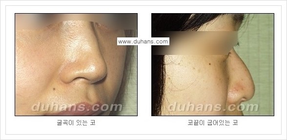 [두한성형외과 경쟁력 미세지방이식] - [코 미세지방이식 안내] 관련 이미지 4
