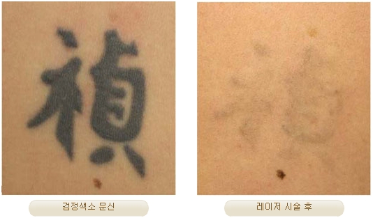 Duhan Plastic Surgery Laser Treatment - Mole Removal, Spot Removal, Melasma, Blemishes, Hyperpigmentation, Skin Tone Improvement, Elasticity Improvement, Skin Texture Improvement image 32