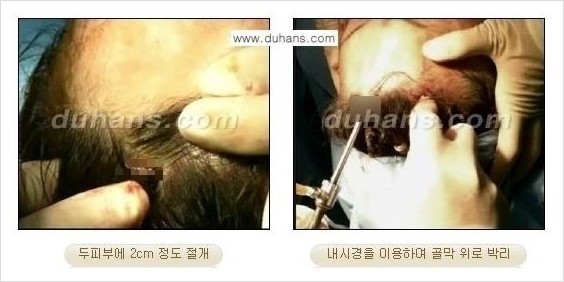 [두한성형외과 주름성형] - [주름교정술 - 강력한 리프팅 파워 엔도타인 리프팅 ] 관련 이미지 22