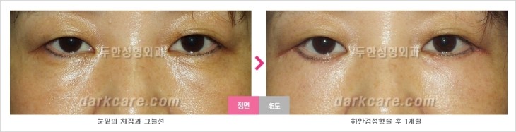 두한성형외과 눈밑수술 - 다크서클 수술 전후 관리 안내 관련 이미지 87