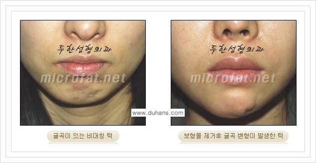 ⁠⁠[두한성형외과 경쟁력 미세지방이식] - [턱 미세지방이식 - 안면윤곽 교정 안내] 관련 이미지 2