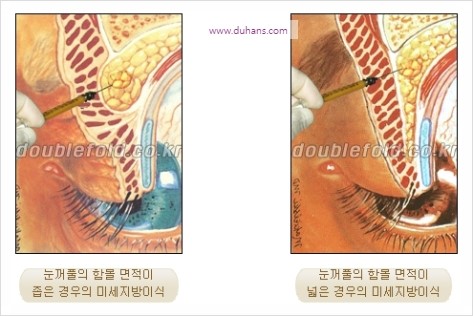 [두한성형외과 경쟁력 눈성형] - [극한 재수술, 함몰된 눈꺼풀 라인교정, 안검하수(졸리운 눈매)] 관련 이미지 37