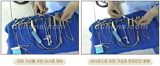두한성형외과 안티에이징 리프팅 - 엔도타인 리프팅 관련 이미지 20