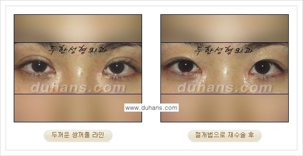 [두한성형외과 경쟁력 쌍꺼풀 재수술, 극한 재수술] - [두꺼운 쌍꺼풀 라인의 교정 방법 안내] 관련 이미지 6